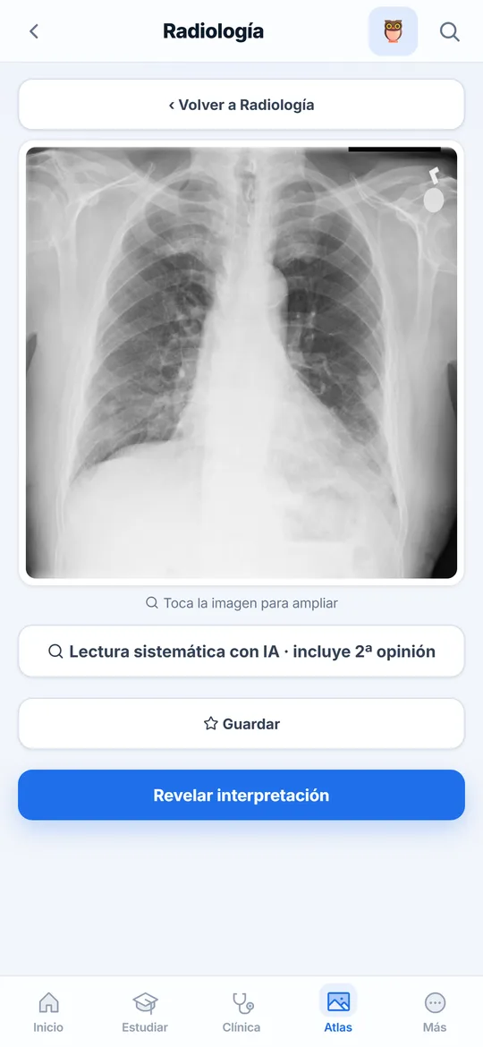 Radiografía de tórax del atlas, con la interpretación oculta